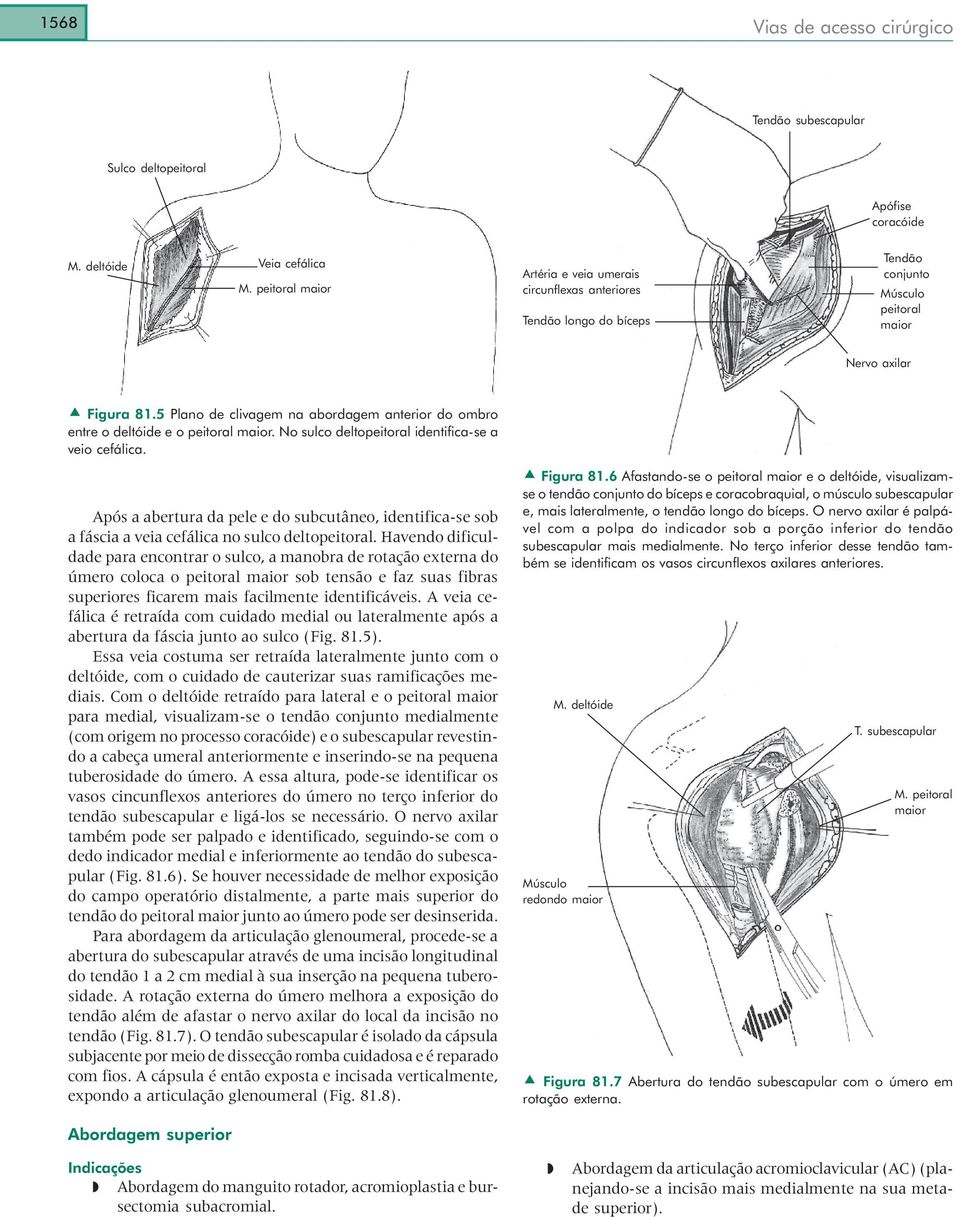 5 Plano de clivagem na abordagem anterior do ombro entre o deltóide e o peitoral maior. No sulco deltopeitoral identifica-se a veio cefálica.