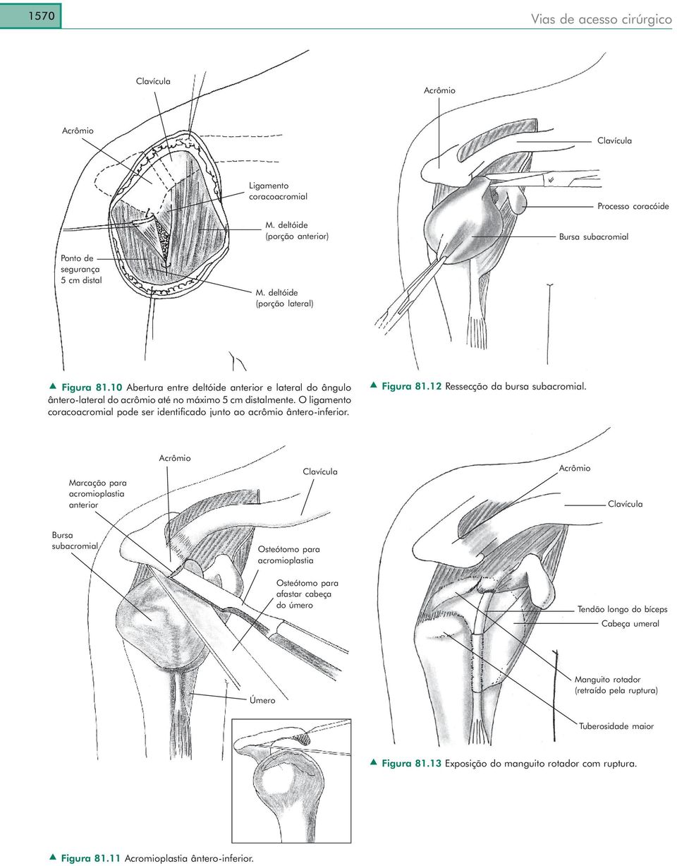 O ligamento coracoacromial pode ser identificado junto ao acrômio ântero-inferior. Figura 81.12 Ressecção da bursa subacromial.