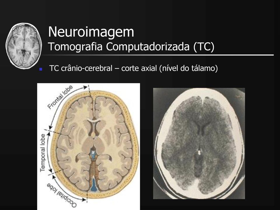 TC crânio-cerebral