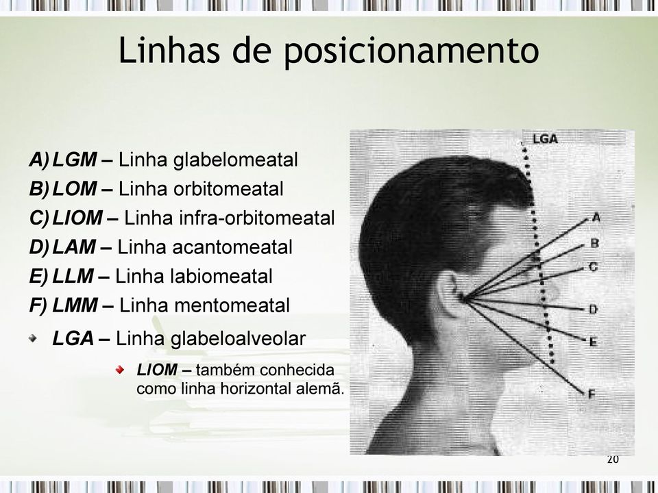 acantomeatal E) LLM Linha labiomeatal F) LMM Linha mentomeatal LGA