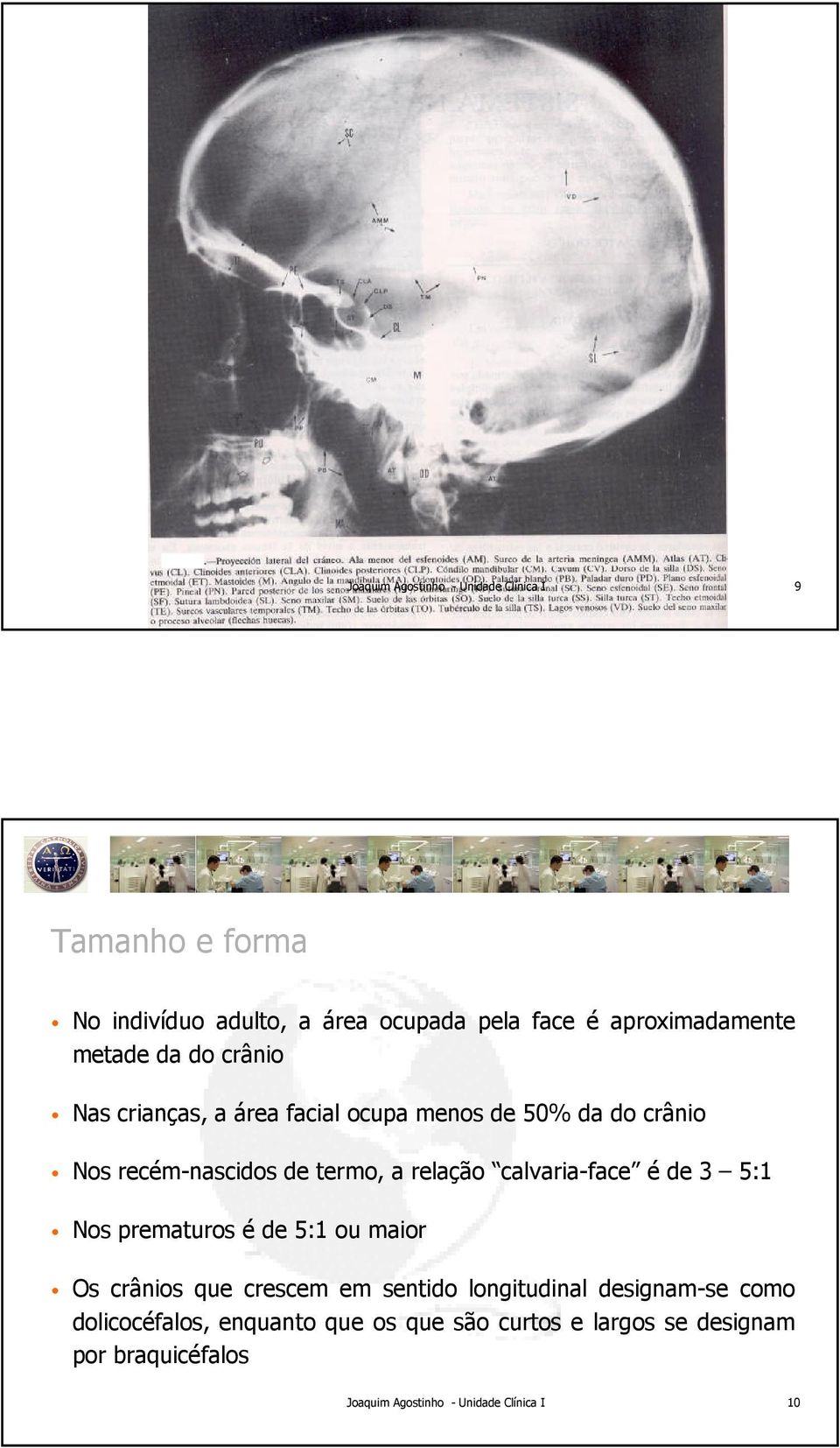 recém-nascidos de termo, a relação calvaria-face é de 3 5:1 Nos prematuros é de 5:1 ou maior Os crânios que