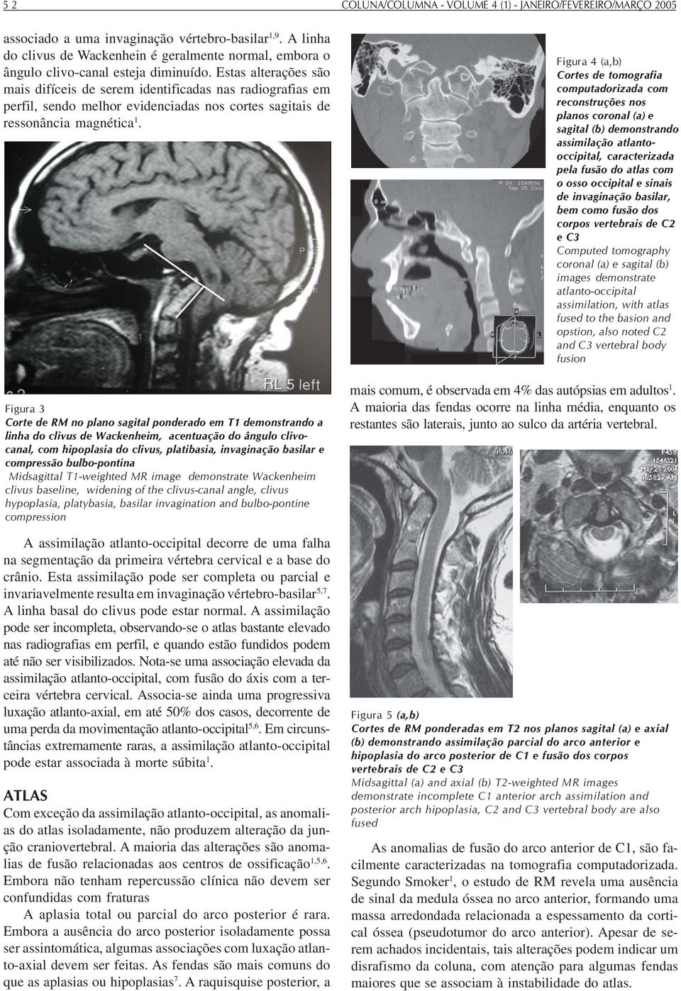 Estas alterações são mais difíceis de serem identificadas nas radiografias em perfil, sendo melhor evidenciadas nos cortes sagitais de ressonância magnética 1.