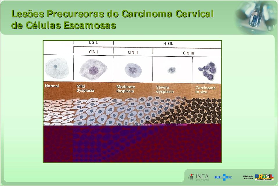 Carcinoma