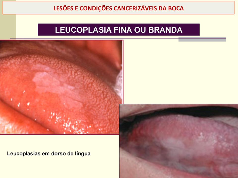 LEUCOPLASIA FINA OU