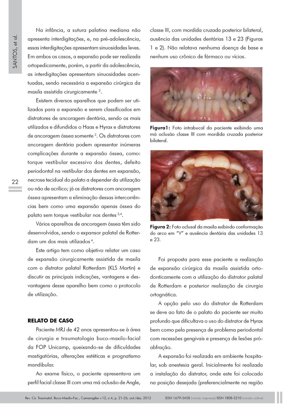 maxila assistida cirurgicamente 2.