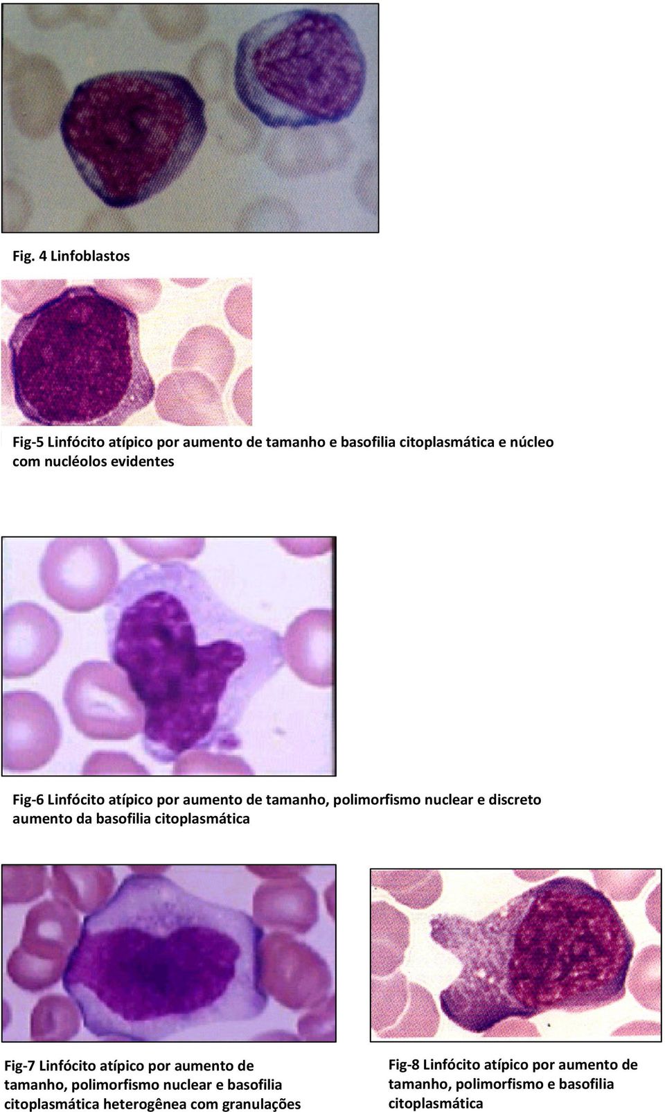 basofilia citoplasmática Fig-7 Linfócito atípico por aumento de tamanho, polimorfismo nuclear e basofilia