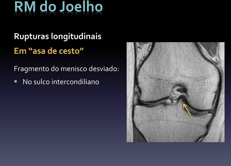 Fragmento do menisco