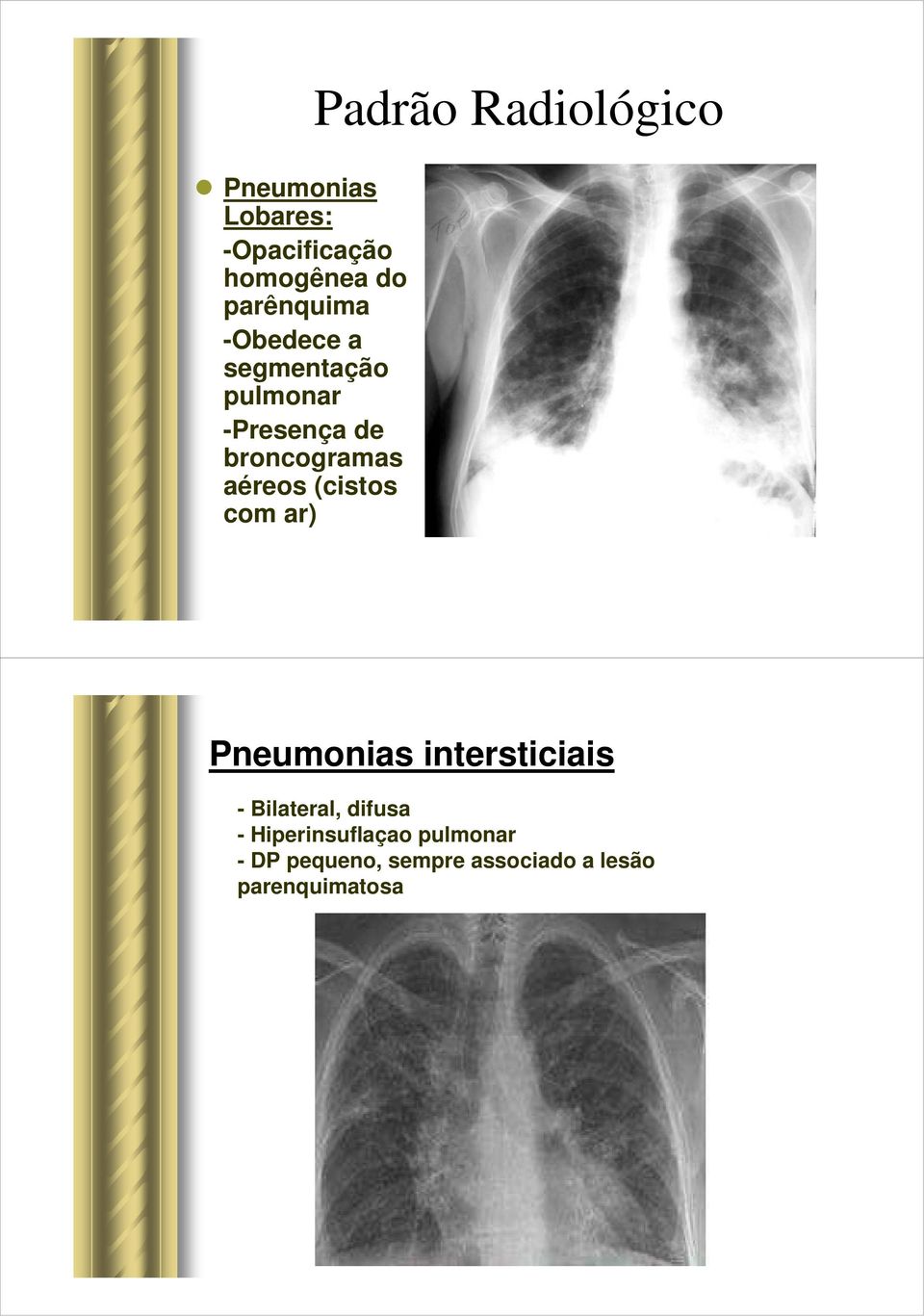 Padrão Radiológico Pneumonias intersticiais - Bilateral, difusa -