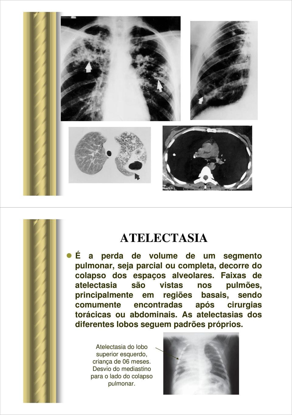 Faixas de atelectasia são vistas nos pulmões, principalmente em regiões basais, sendo comumente encontradas após