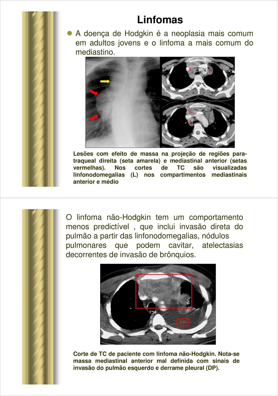 Nos cortes de TC são visualizadas linfonodomegalias (L) nos compartimentos mediastinais anterior e médio O linfoma não-hodgkin tem um comportamento menos predictível, que inclui