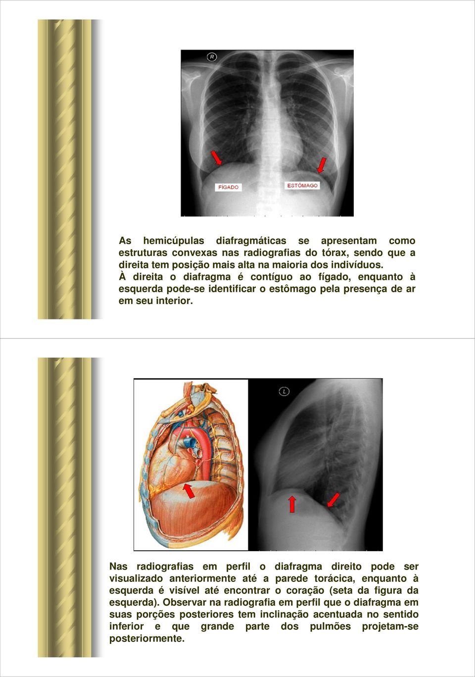 Nas radiografias em perfil o diafragma direito pode ser visualizado anteriormente até a parede torácica, enquanto à esquerda é visível até encontrar o coração (seta