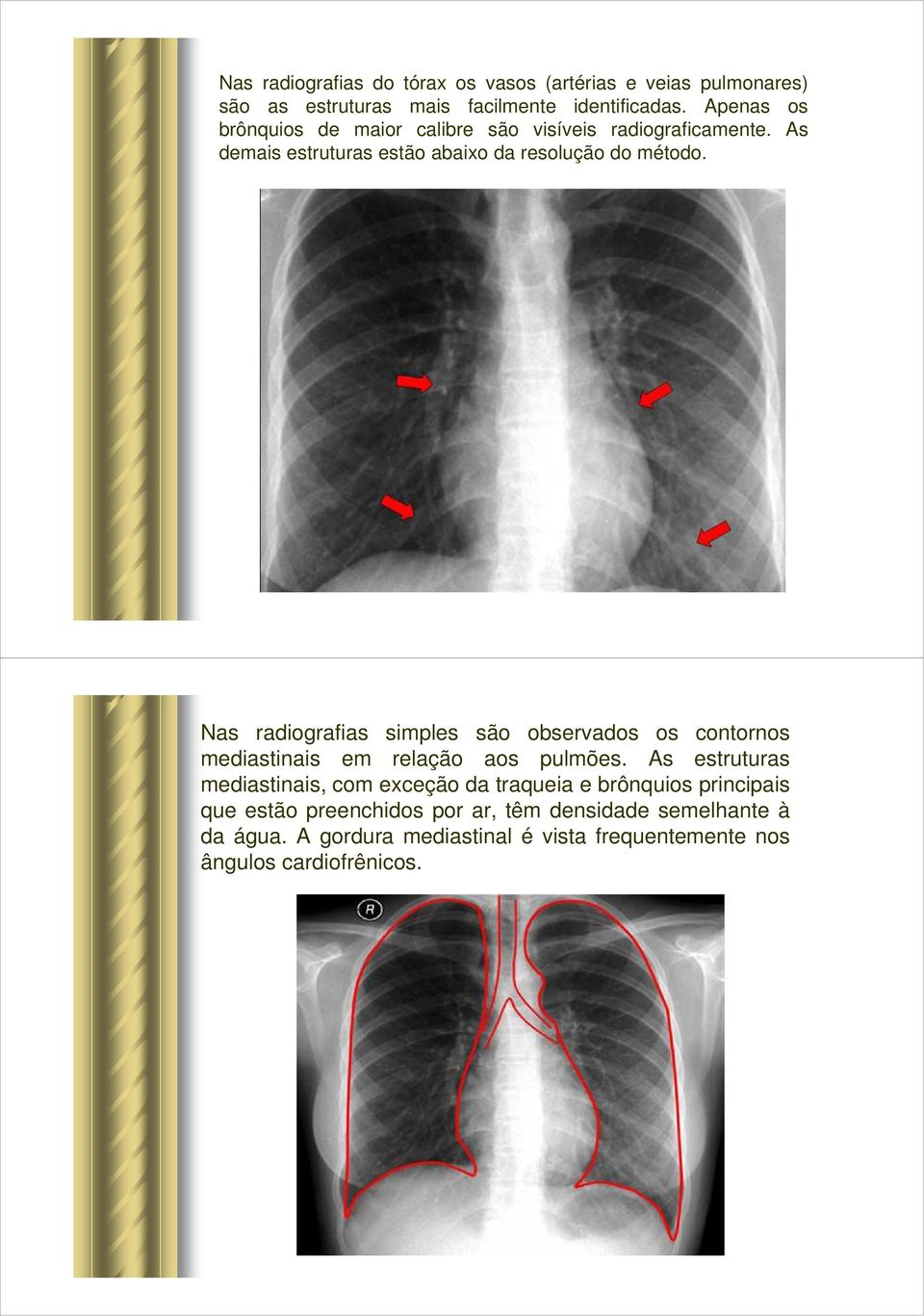 Nas radiografias simples são observados os contornos mediastinais em relação aos pulmões.