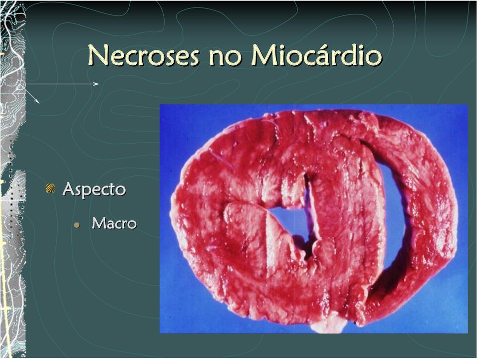 Miocárdio