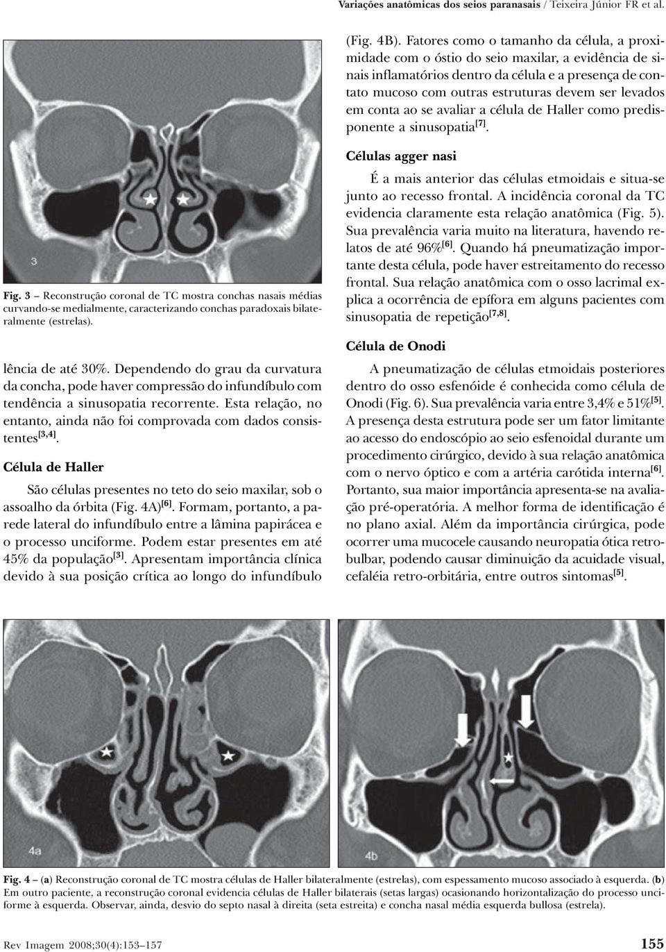 levados em conta ao se avaliar a célula de Haller como predisponente a sinusopatia [7]. Fig.