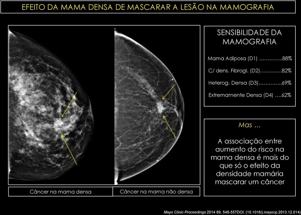 62% Mas Câncer na mama densa Câncer na mama não densa A associação entre aumento do risco na mama densa é