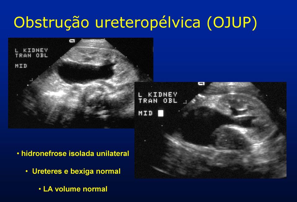 isolada unilateral