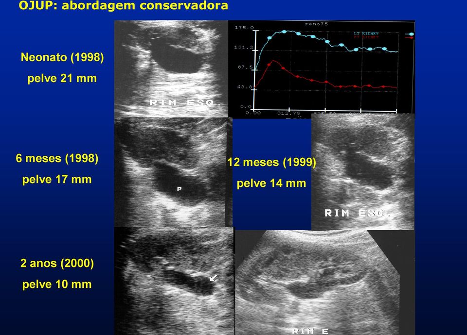 meses (1998) pelve 17 mm 12 meses
