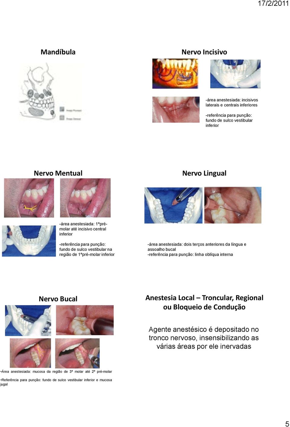 língua e assoalho bucal -referência para punção: linha oblíqua interna Nervo Bucal Anestesia Local Troncular, Regional ou Bloqueio de Condução Agente anestésico é depositado no tronco