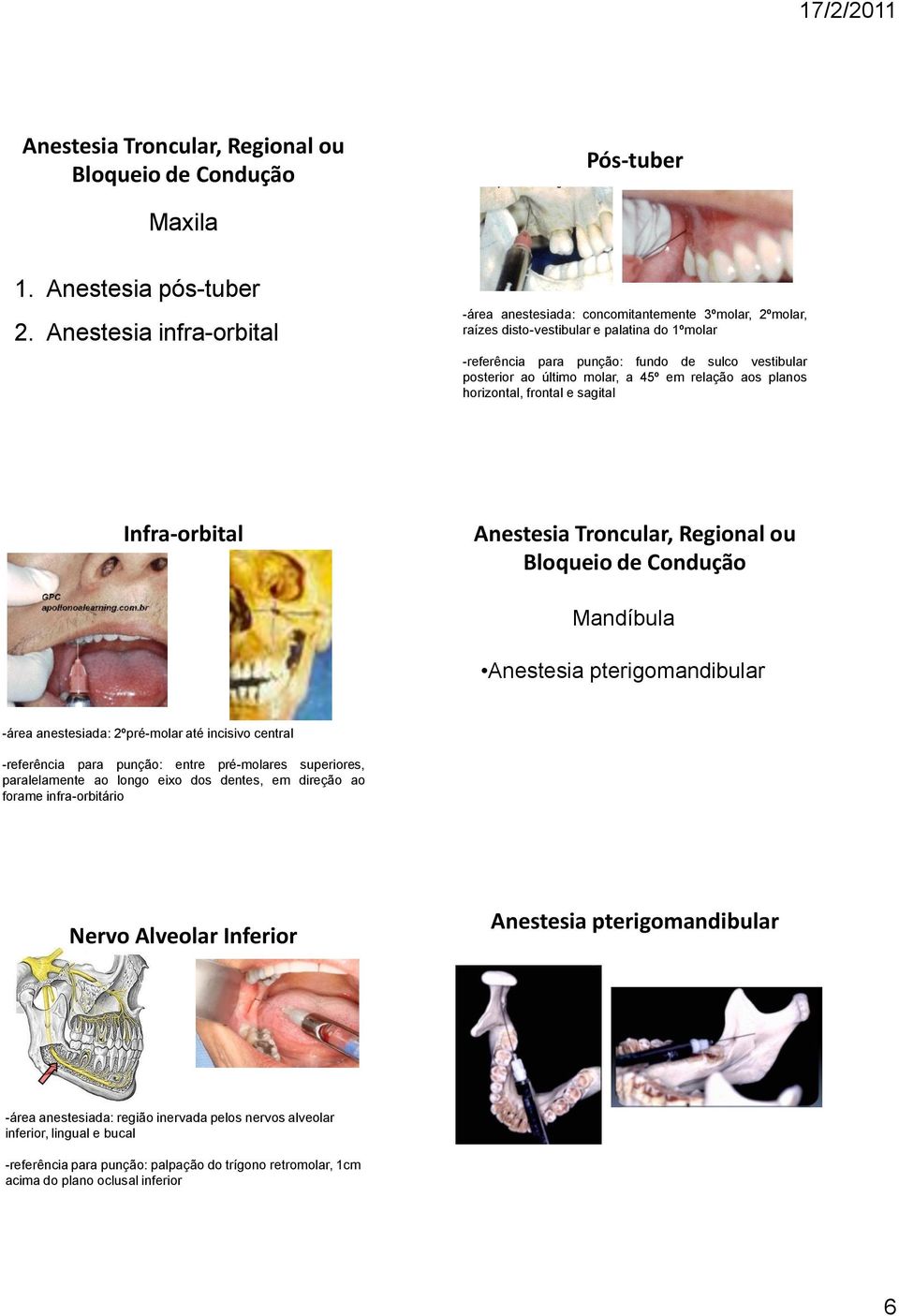 molar, a 45º em relação aos planos horizontal, frontal e sagital Infra-orbital Anestesia Troncular, Regional ou Bloqueio de Condução Mandíbula Anestesia pterigomandibular -área anestesiada: