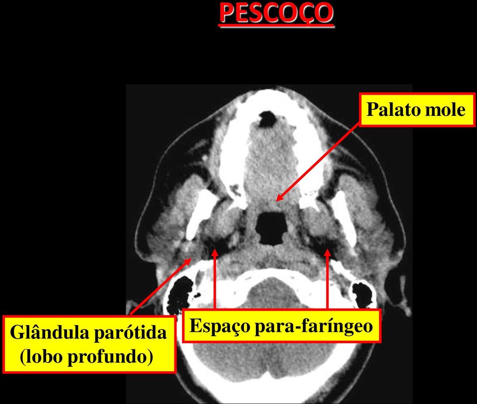 parótida (lobo