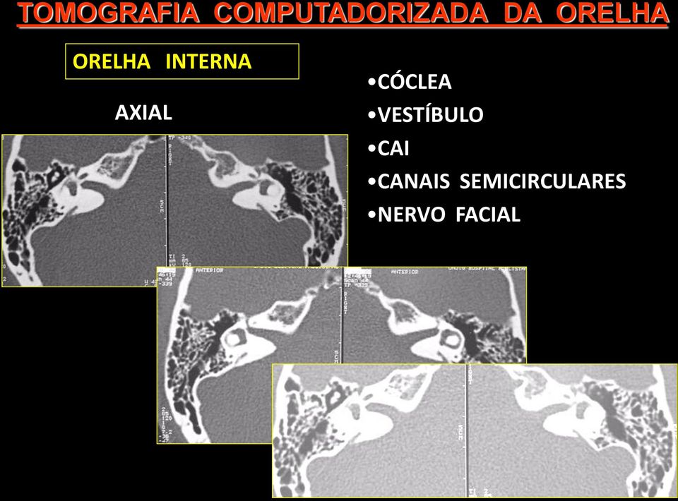 AXIAL CÓCLEA VESTÍBULO CAI