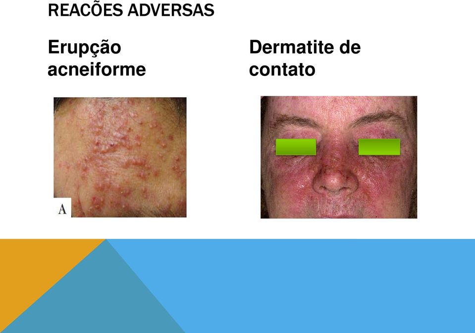 dermatite acneiforme)