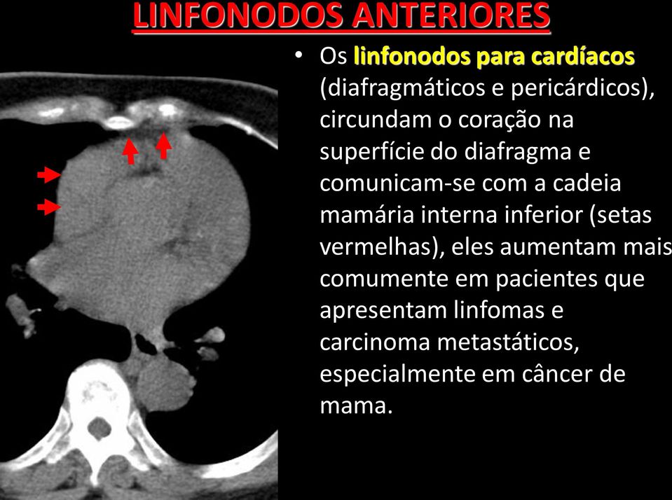 a cadeia mamária interna inferior (setas vermelhas), eles aumentam mais comumente