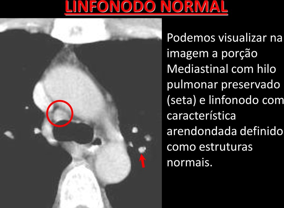 pulmonar preservado (seta) e linfonodo com