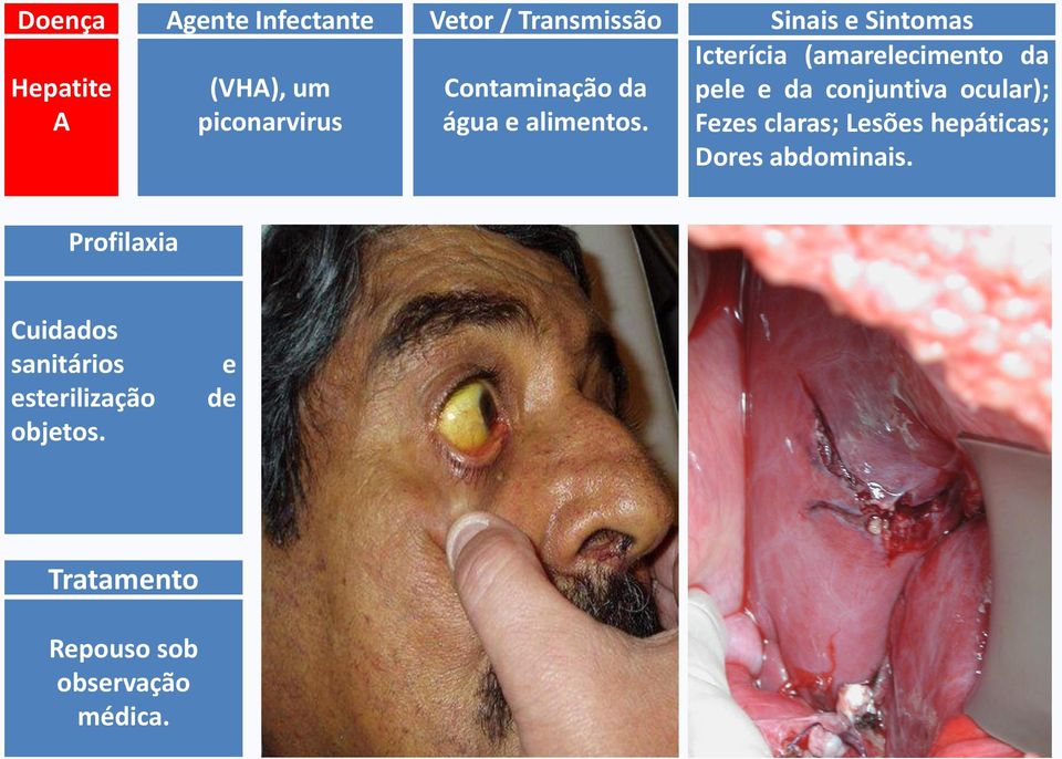 Sinais e Sintomas Icterícia (amarelecimento da pele e da conjuntiva ocular); Fezes