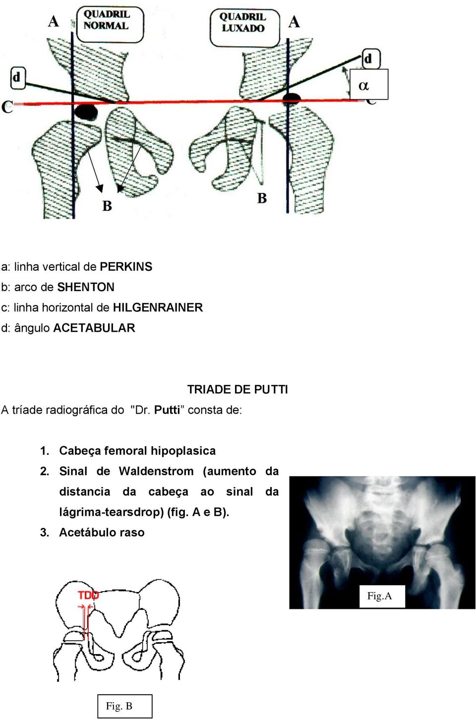 Putti consta de: 1. Cabeça femoral hipoplasica 2.