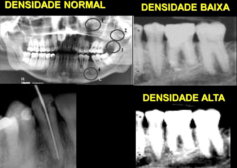 Densidade Baixa