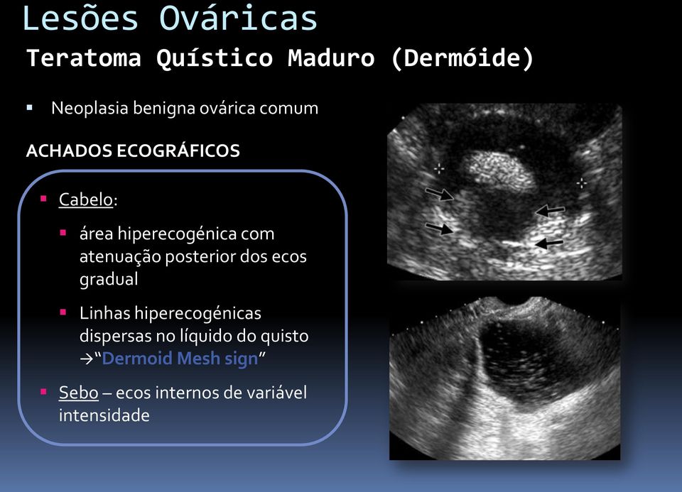 atenuação posterior dos ecos gradual Linhas hiperecogénicas dispersas