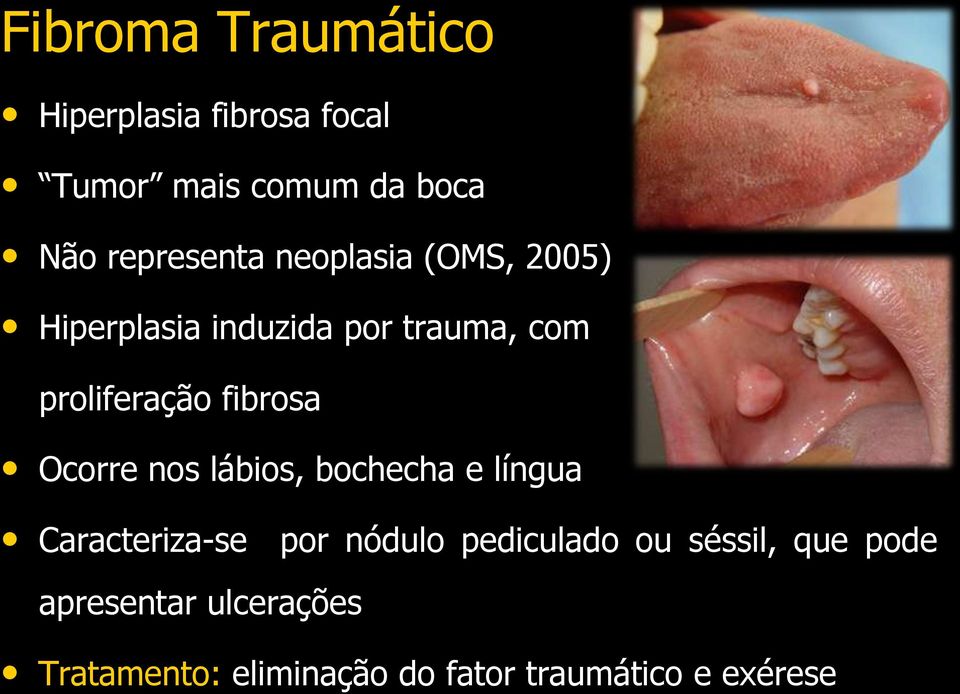 fibrosa Ocorre nos lábios, bochecha e língua Caracteriza-se por nódulo pediculado