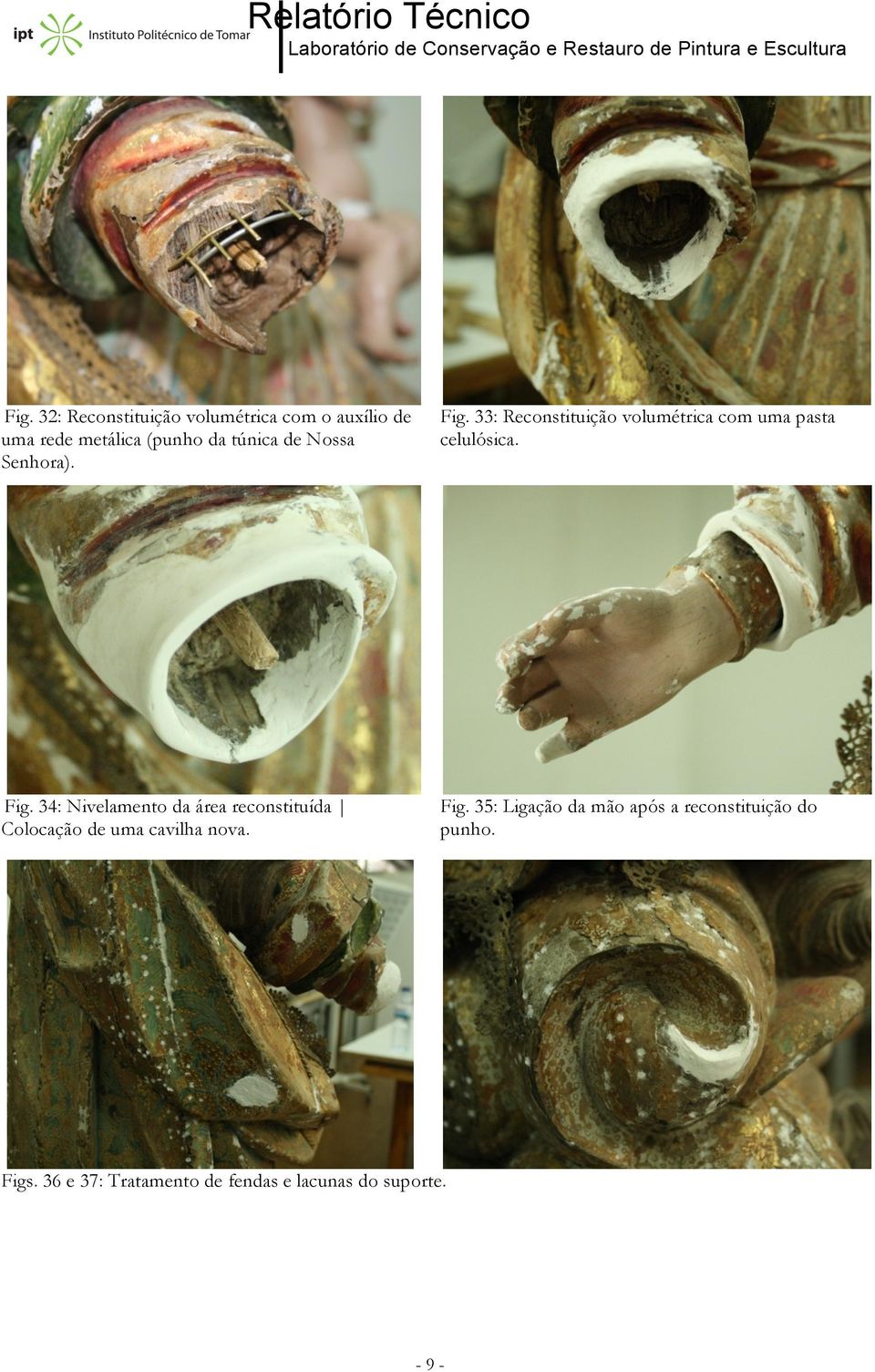 Fig. 35: Ligação da mão após a reconstituição do punho. Figs.