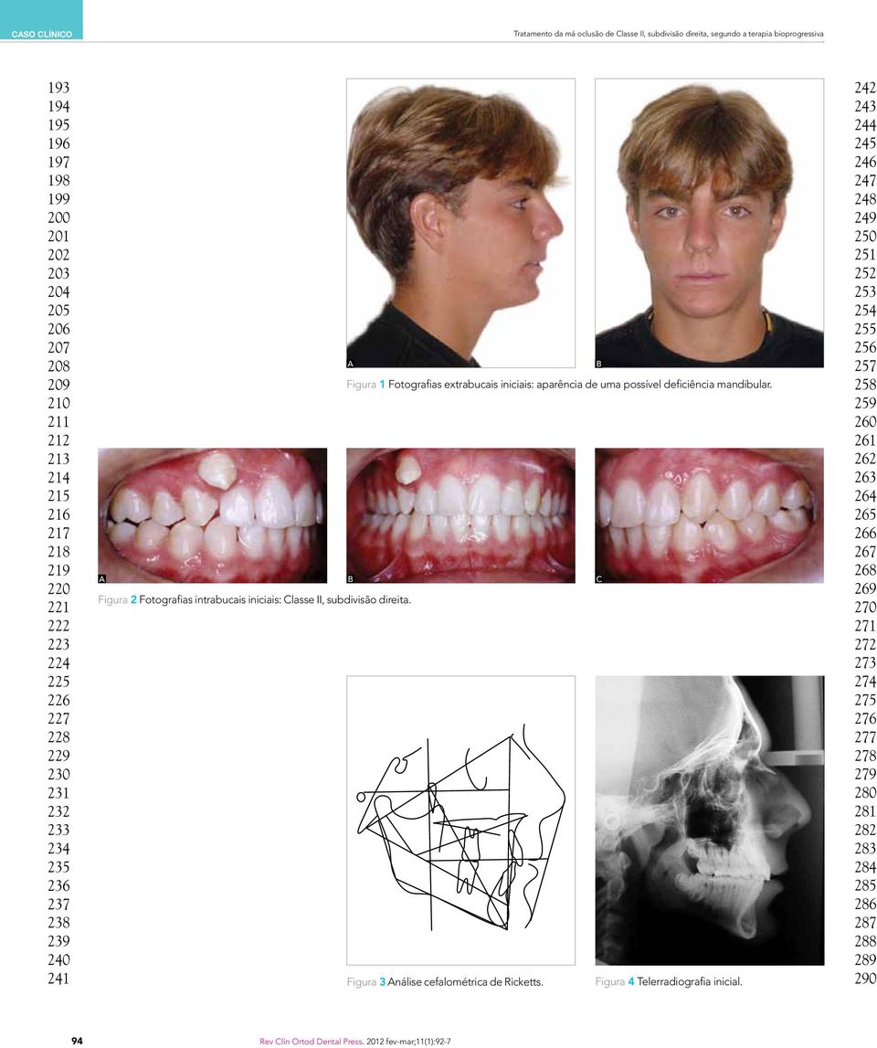 A B C Figura 2 Fotografias intrabucais iniciais: Classe II, subdivisão direita. Figura 3 Análise cefalométrica de Ricketts. Figura 4 Telerradiografia inicial.