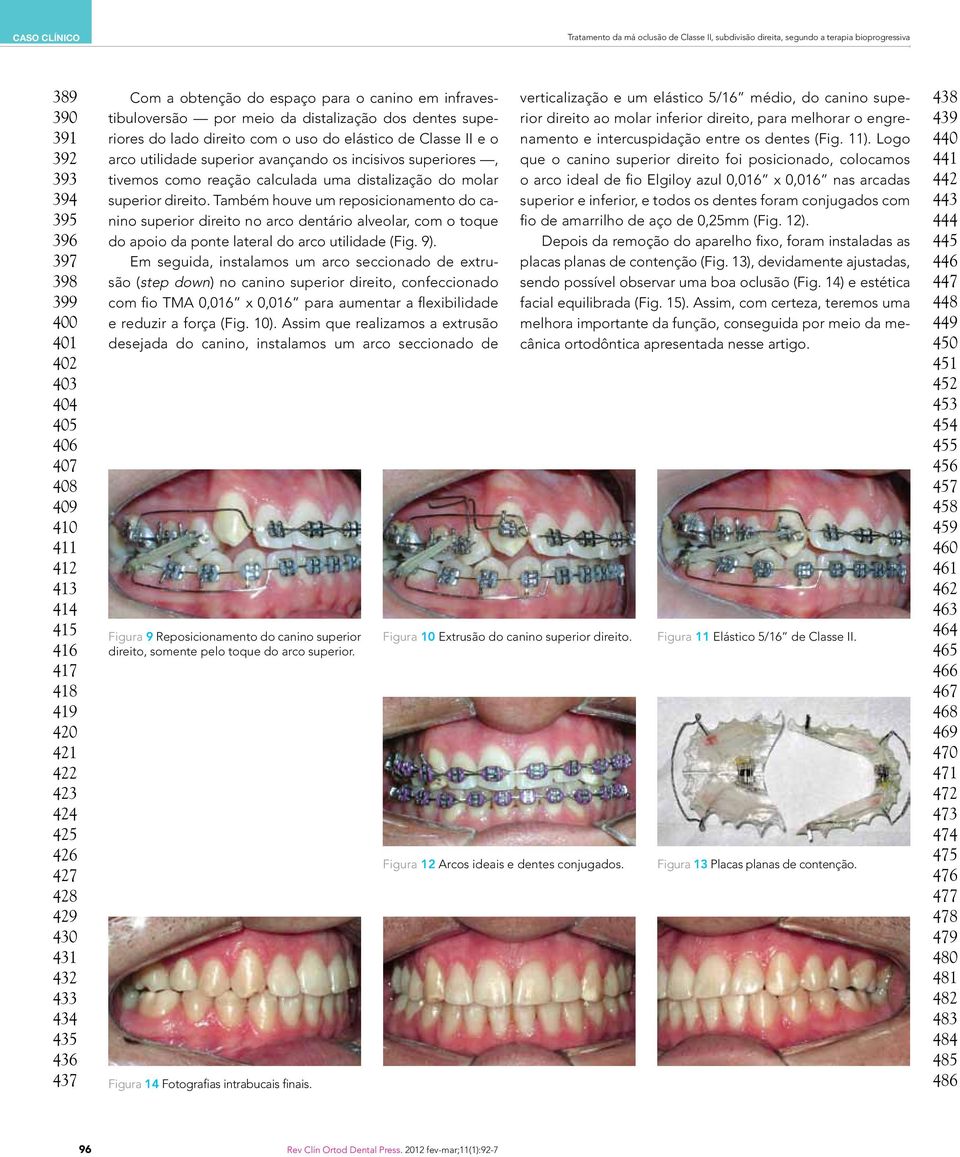 dentes superiores do lado direito com o uso do elástico de Classe II e o arco utilidade superior avançando os incisivos superiores, tivemos como reação calculada uma distalização do molar superior