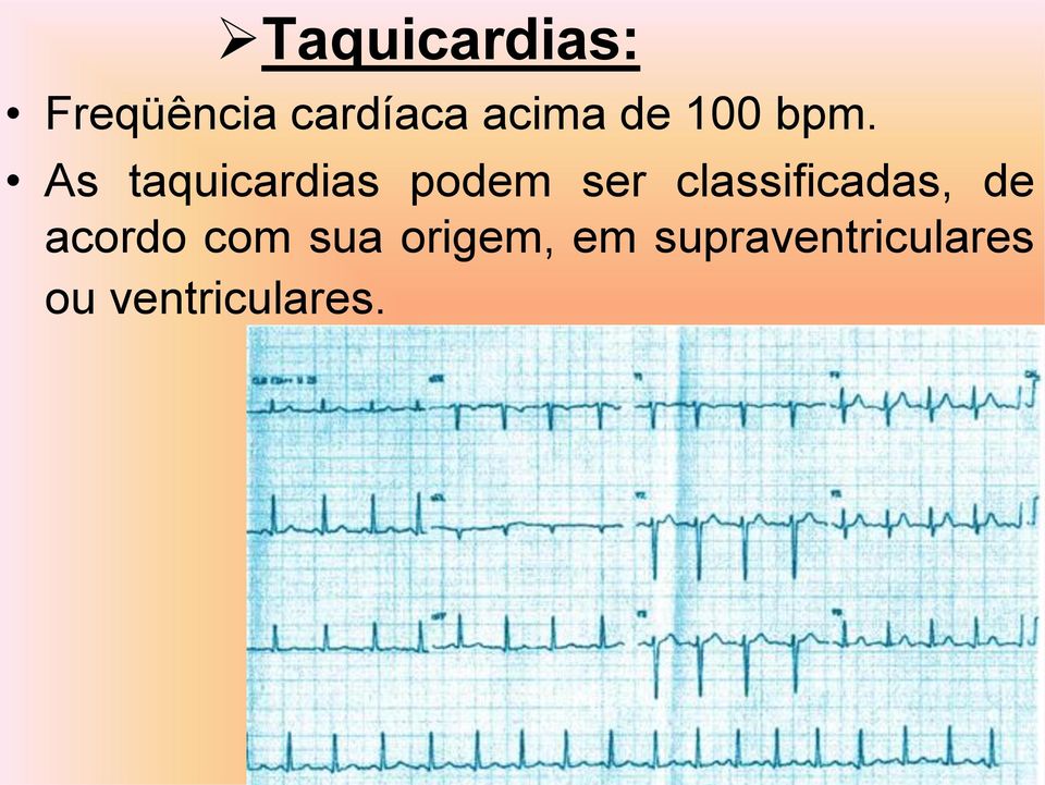 As taquicardias podem ser