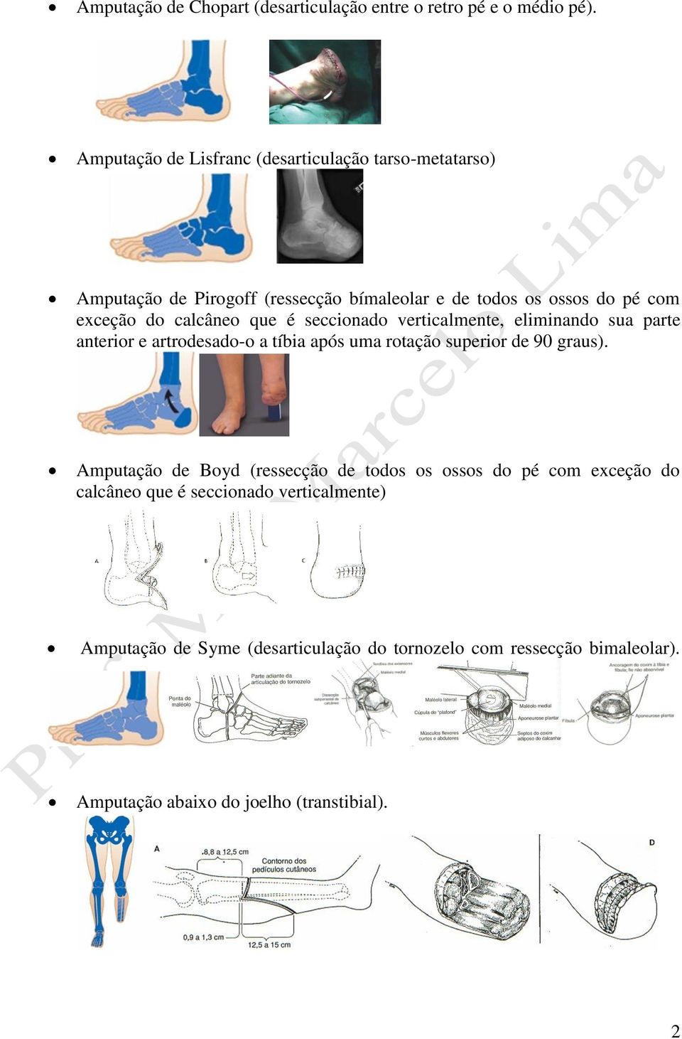 calcâneo que é seccionado verticalmente, eliminando sua parte anterior e artrodesado-o a tíbia após uma rotação superior de 90 graus).