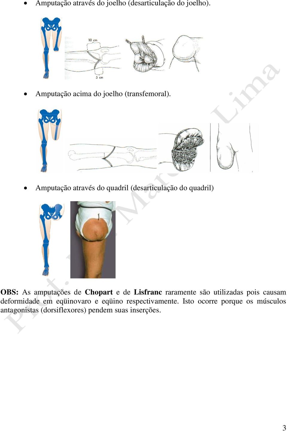 Amputação através do quadril (desarticulação do quadril) OBS: As amputações de Chopart e de