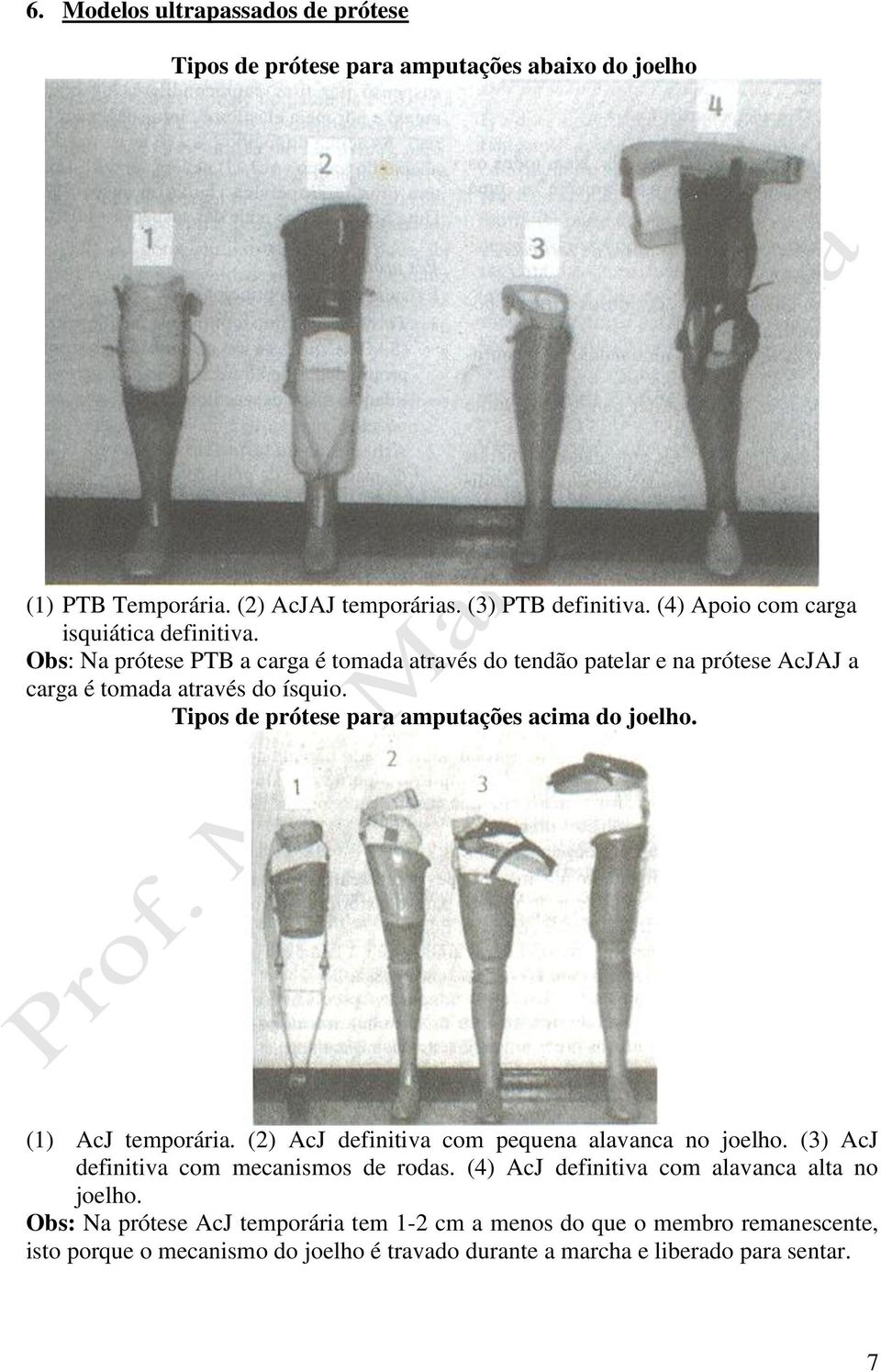 Tipos de prótese para amputações acima do joelho. (1) AcJ temporária. (2) AcJ definitiva com pequena alavanca no joelho. (3) AcJ definitiva com mecanismos de rodas.