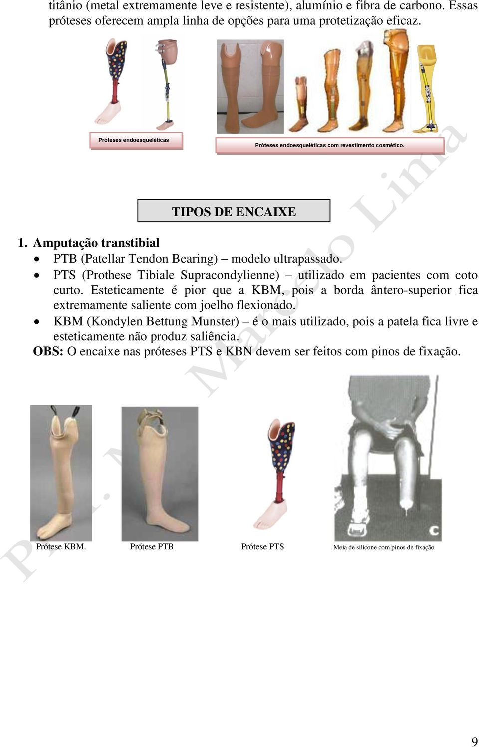 PTS (Prothese Tibiale Supracondylienne) utilizado em pacientes com coto curto. Esteticamente é pior que a KBM, pois a borda ântero-superior fica extremamente saliente com joelho flexionado.