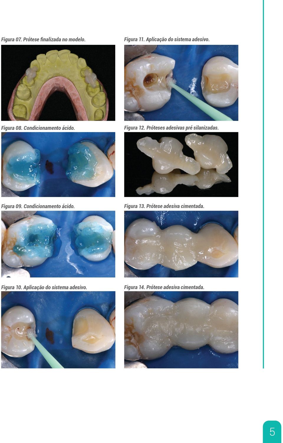 Pro teses adesivas pre silanizadas. Figura 09. Condicionamento a cido. Figura 13.