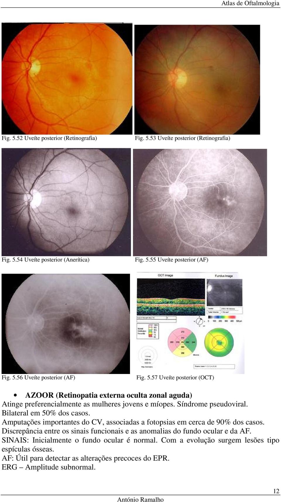 Amputações importantes do CV, associadas a fotopsias em cerca de 90% dos casos. Discrepância entre os sinais funcionais e as anomalias do fundo ocular e da AF.