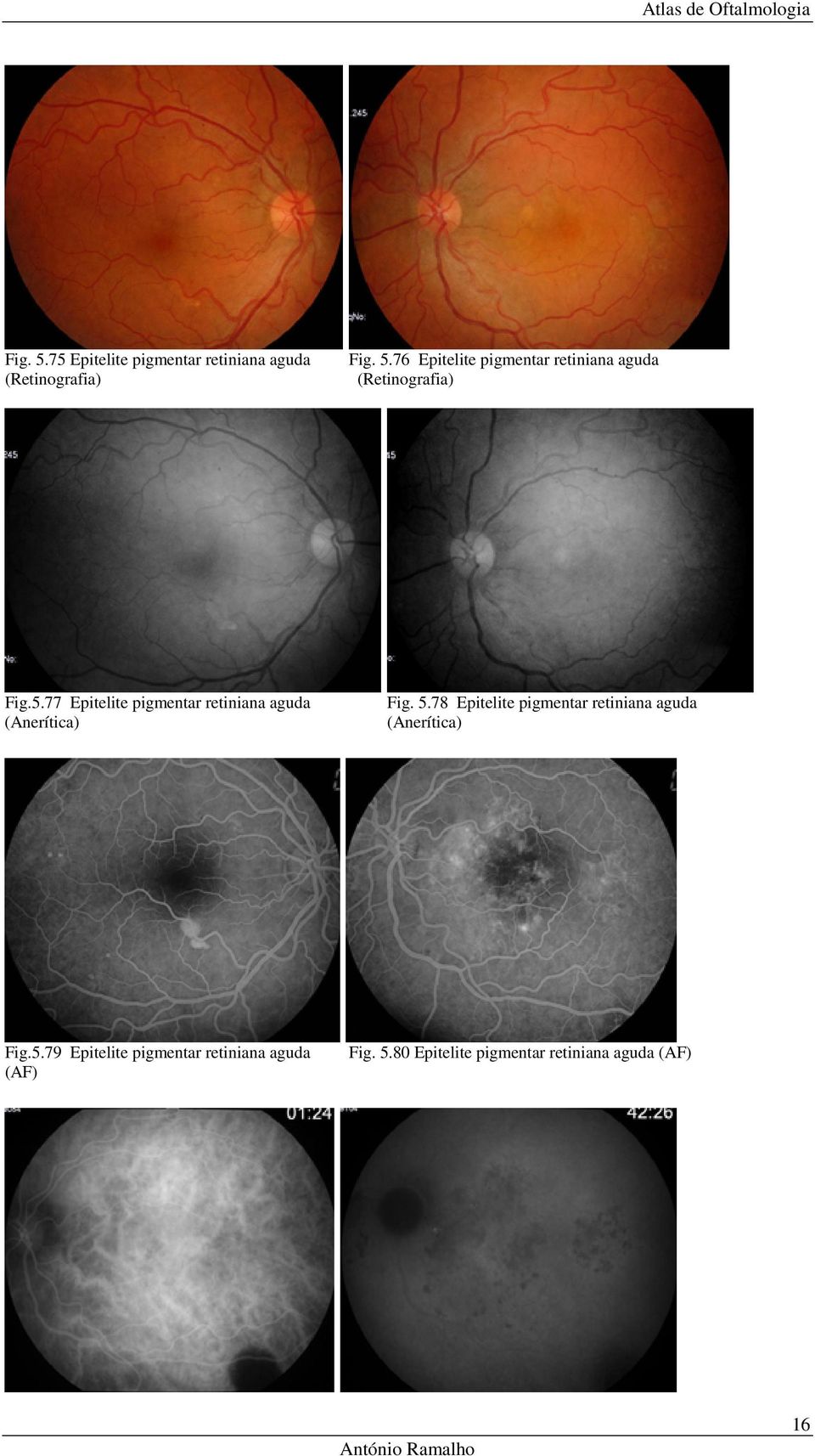 78 Epitelite pigmentar retiniana aguda (Anerítica) Fig.5.