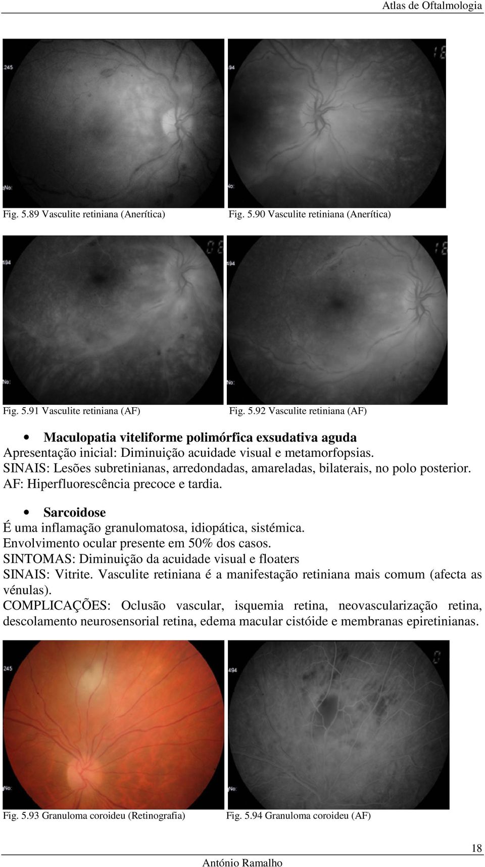 Envolvimento ocular presente em 50% dos casos. SINTOMAS: Diminuição da acuidade visual e floaters SINAIS: Vitrite. Vasculite retiniana é a manifestação retiniana mais comum (afecta as vénulas).