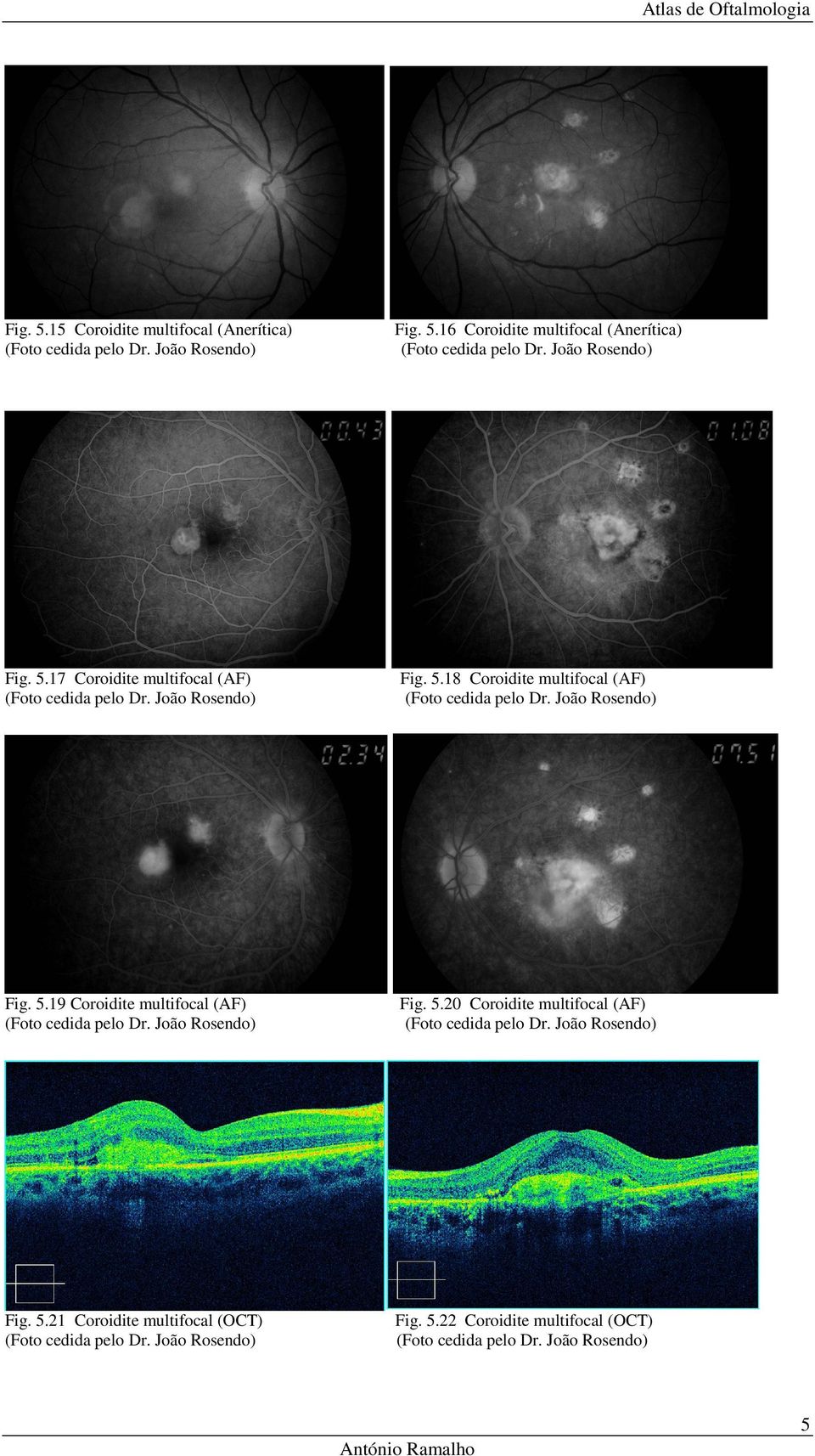 João Rosendo) Fig. 5.19 Coroidite multifocal (AF) (Foto cedida pelo Dr. João Rosendo) Fig. 5.20 Coroidite multifocal (AF) (Foto cedida pelo Dr.