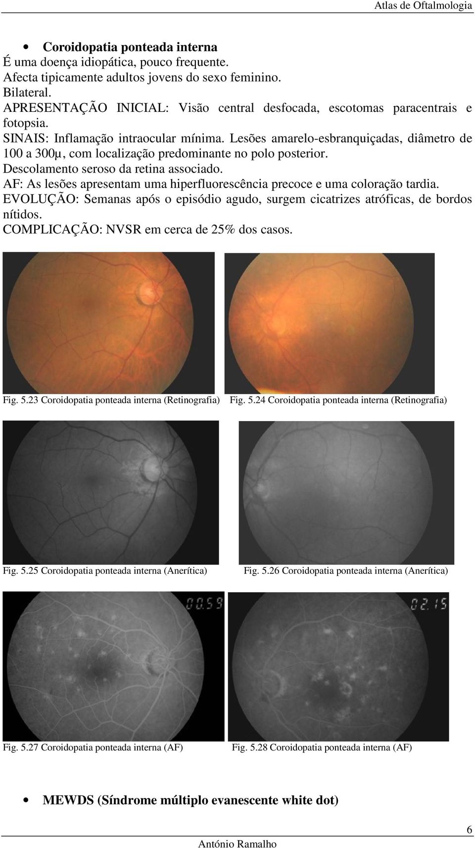 Lesões amarelo-esbranquiçadas, diâmetro de 100 a 300µ, com localização predominante no polo posterior. Descolamento seroso da retina associado.