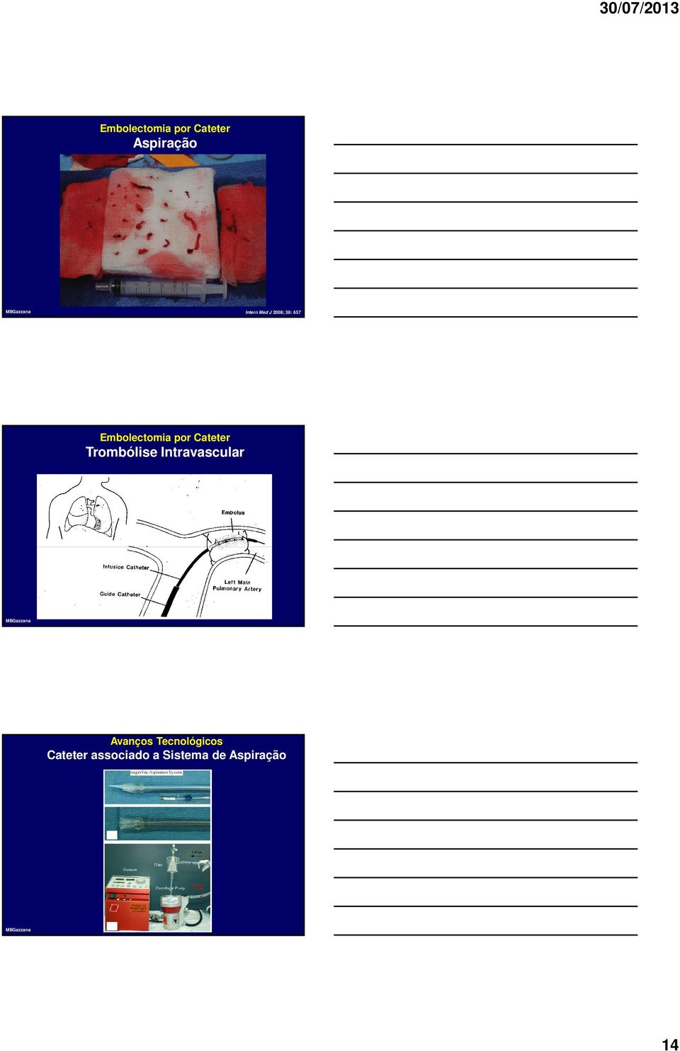 Intravascular Avanços