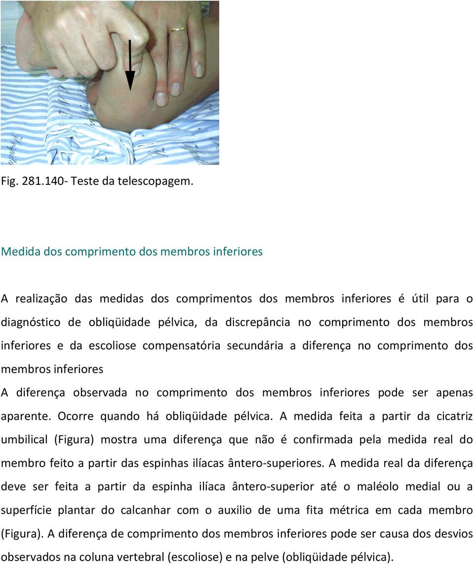 membros inferiores e da escoliose compensatória secundária a diferença no comprimento dos membros inferiores A diferença observada no comprimento dos membros inferiores pode ser apenas aparente.