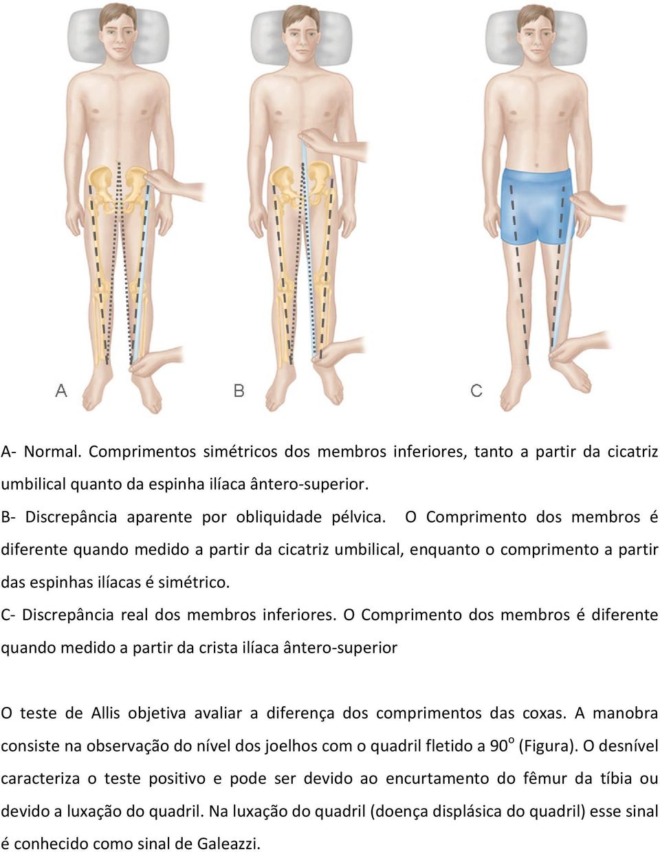 O Comprimento dos membros é diferente quando medido a partir da crista ilíaca ântero-superior O teste de Allis objetiva avaliar a diferença dos comprimentos das coxas.